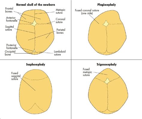weird shaped head|abnormal skull shapes.